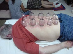 Amazing Thai Cupping Therapy